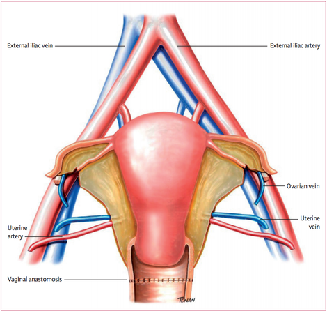 An illustration of how the uterine transplant was performed.